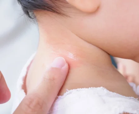 Childhood Eczema Specialist