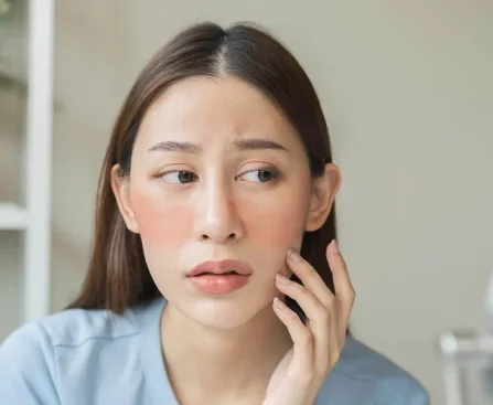 aInsights Into Lupus Treatment Singapore Patients Should Understand